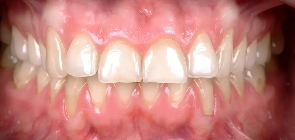 Дистальный прикус - Кейс 14 — вид спереди до лечения