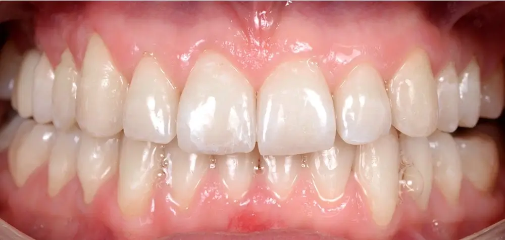 Дистальный прикус - Кейс 3 — вид спереди после лечения