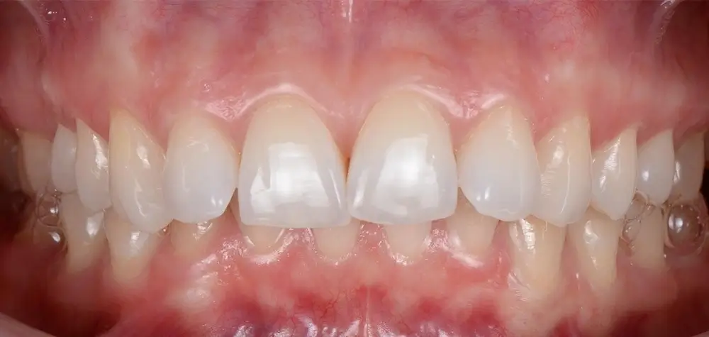 Дистальный прикус - Кейс 4 — вид спереди до лечения