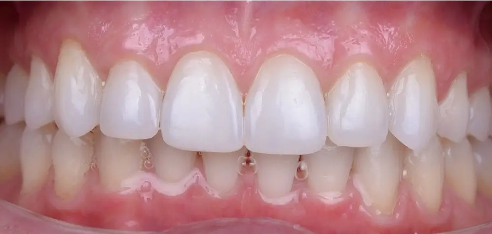 Дистальный прикус - Кейс 4 — вид спереди после лечения