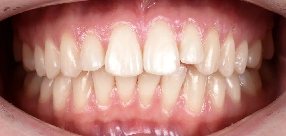 Дистальный прикус - Кейс 5 — вид спереди до лечения