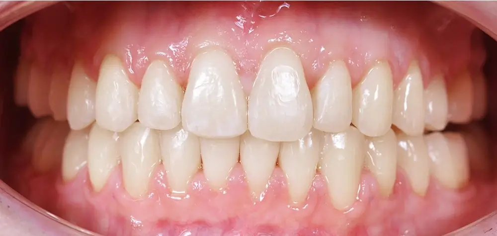 Дистальный прикус - Кейс 5 — вид спереди после лечения