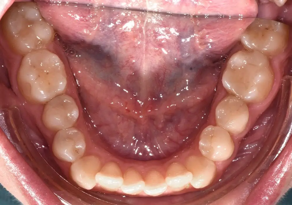 Глубокий прикус - Кейс 1 — нижняя челюсть до лечения