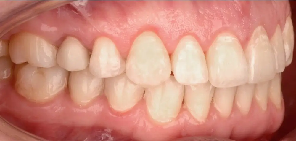 Глубокий прикус - Кейс 1 — боковой ракурс после лечения