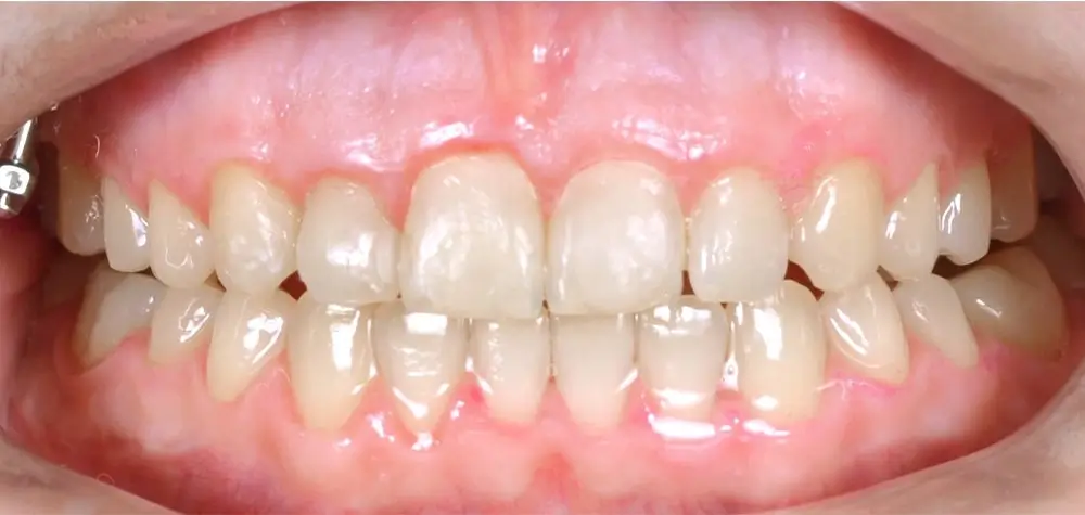 Глубокий прикус - Кейс 2 — фронтальный ракурс после лечения