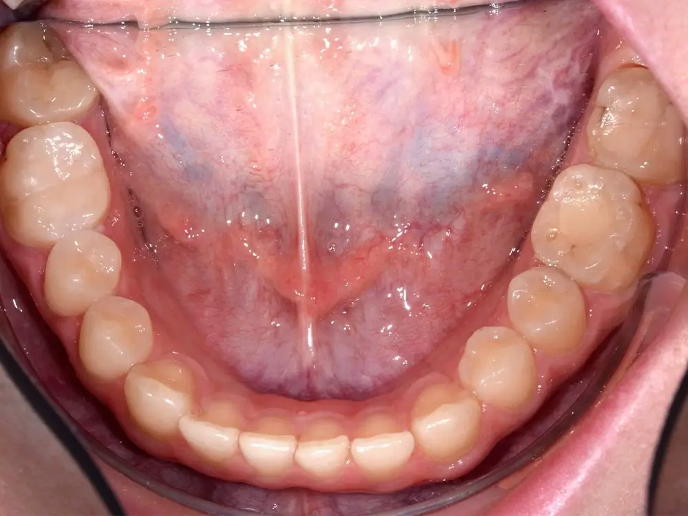 Глубокий прикус - Кейс 2 — нижняя челюсть до лечения