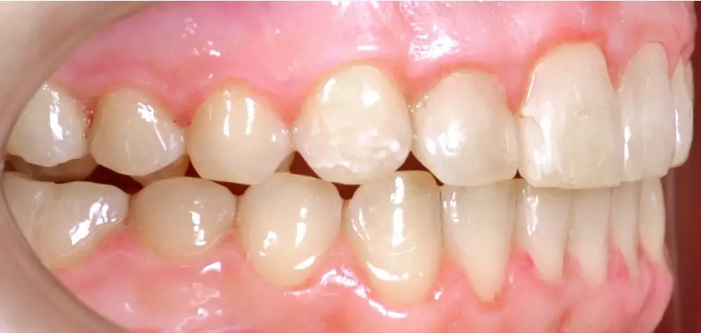 Глубокий прикус - Кейс 2 — боковой ракурс после лечения