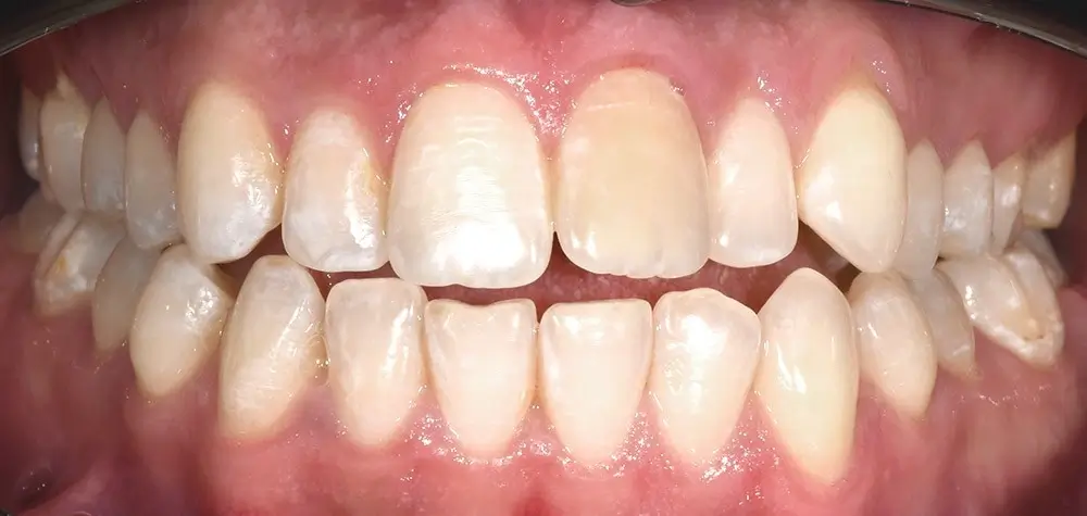 Глубокий прикус - Кейс 3 — фронтальный ракурс до лечения