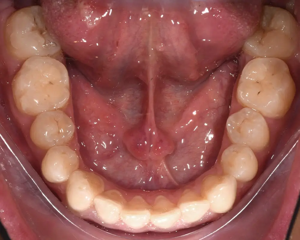 Глубокий прикус - Кейс 3 — нижняя челюсть до лечения