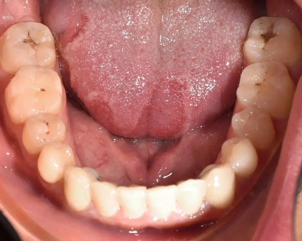 Глубокий прикус - Кейс 3 — нижняя челюсть после лечения