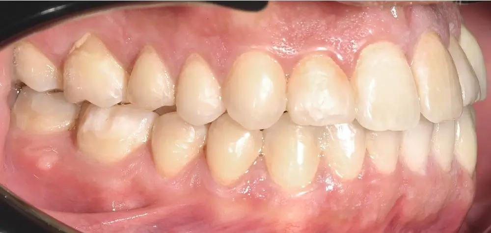 Глубокий прикус - Кейс 3 — боковой ракурс после лечения