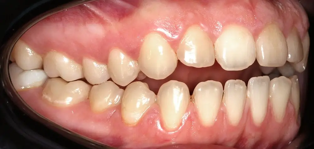 Глубокий прикус - Кейс 4 — боковой ракурс до лечения