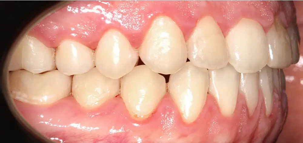 Глубокий прикус - Кейс 4 — боковой ракурс после лечения