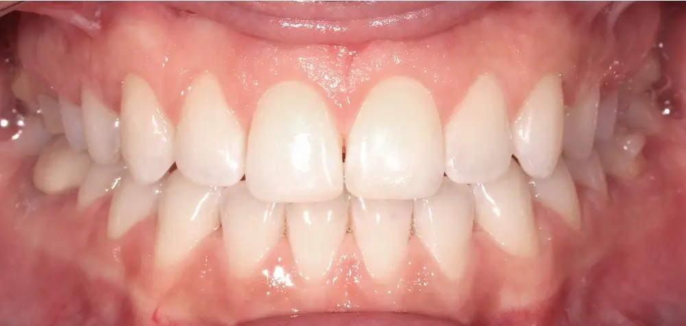 Глубокий прикус - Кейс 5 — фронтальный ракурс после лечения