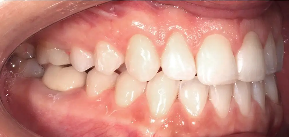 Глубокий прикус - Ке�йс 5 — боковой ракурс после лечения