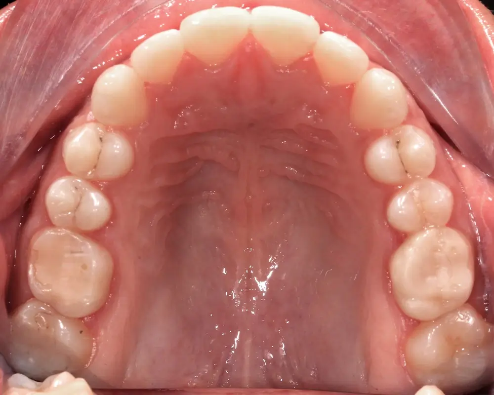 Глубокий прикус - Кейс 5 — верхняя челюсть до лечения