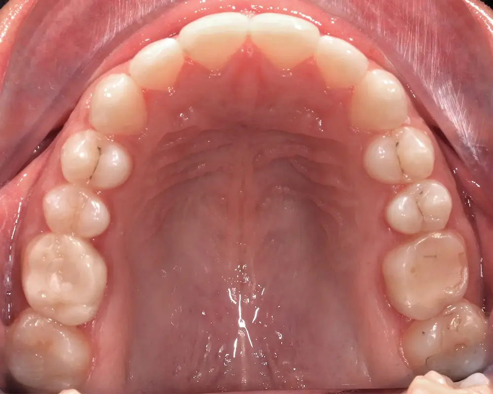 Глубокий прикус - Кейс 5 — верхняя челюсть после лечения