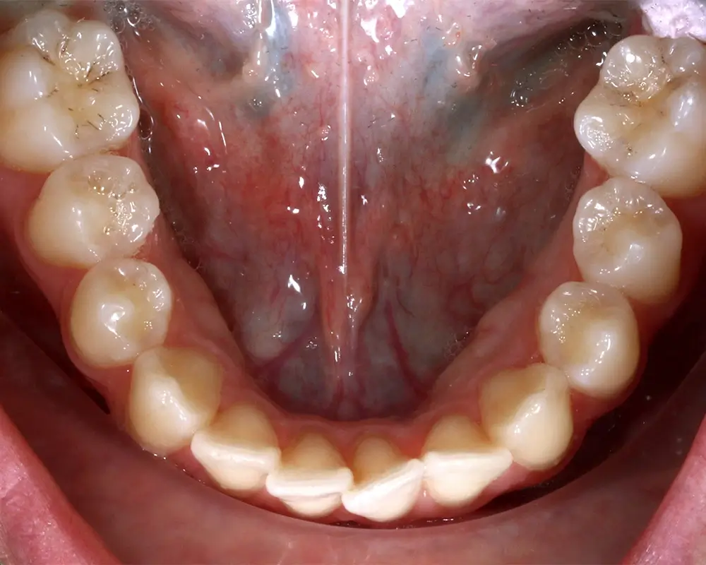 Глубокий прикус - Кейс 6 — нижняя челюсть до лечения