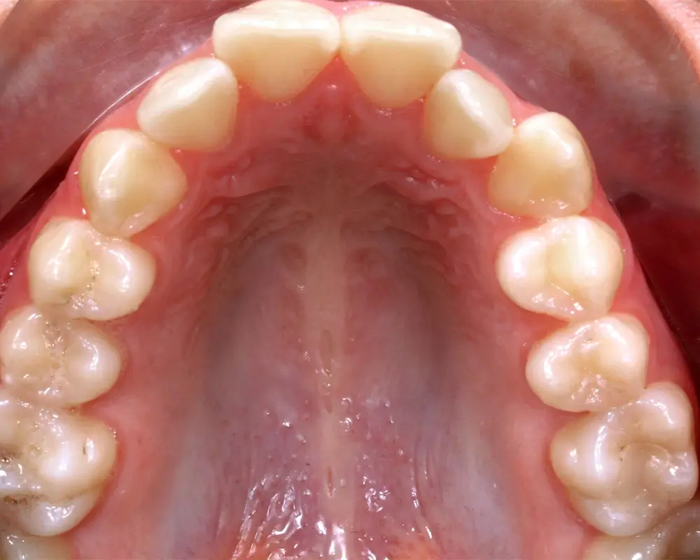 Глубокий прикус - Кейс 6 — верхняя челюсть до лечения
