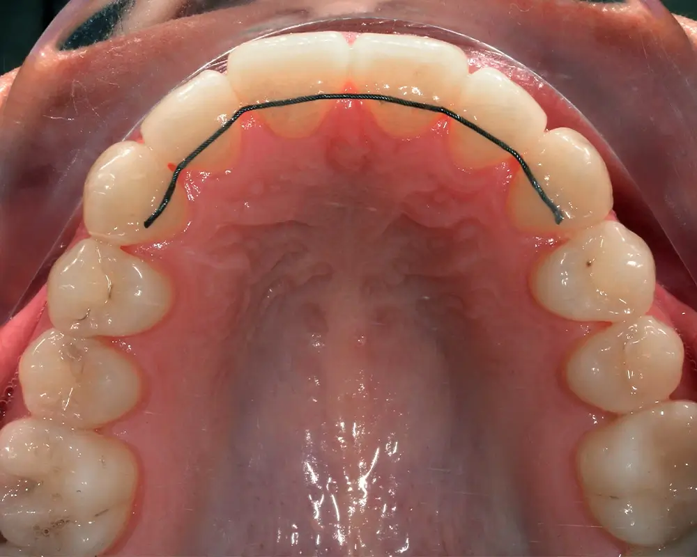 Глубокий прикус - Кейс 6 — верхняя челюсть после лечения