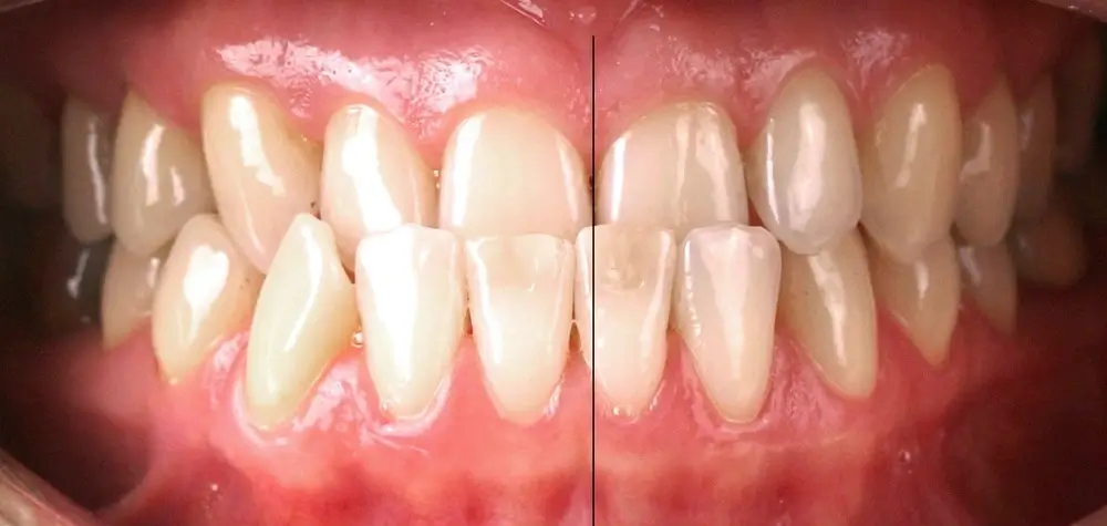 Мезиальный прикус - Кейс 1 — вид спереди до лечения