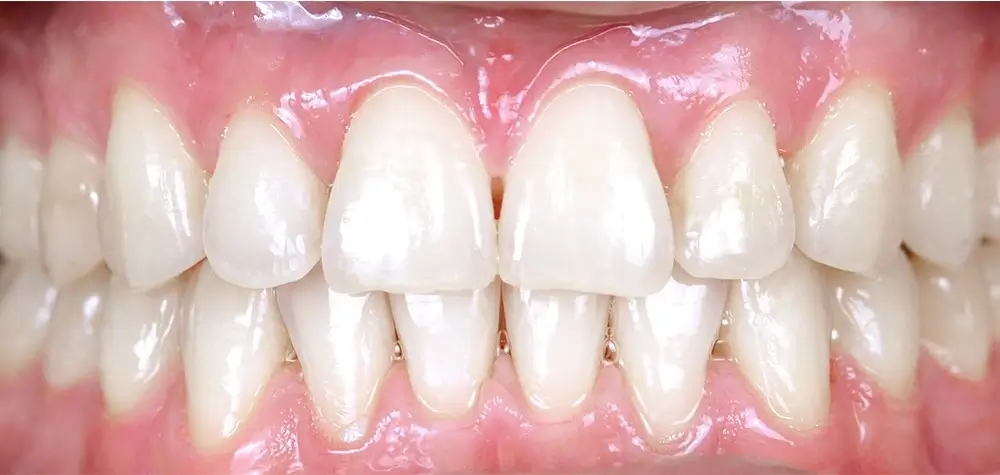 Мезиальный прикус - Кейс 3 — вид спереди после лечения