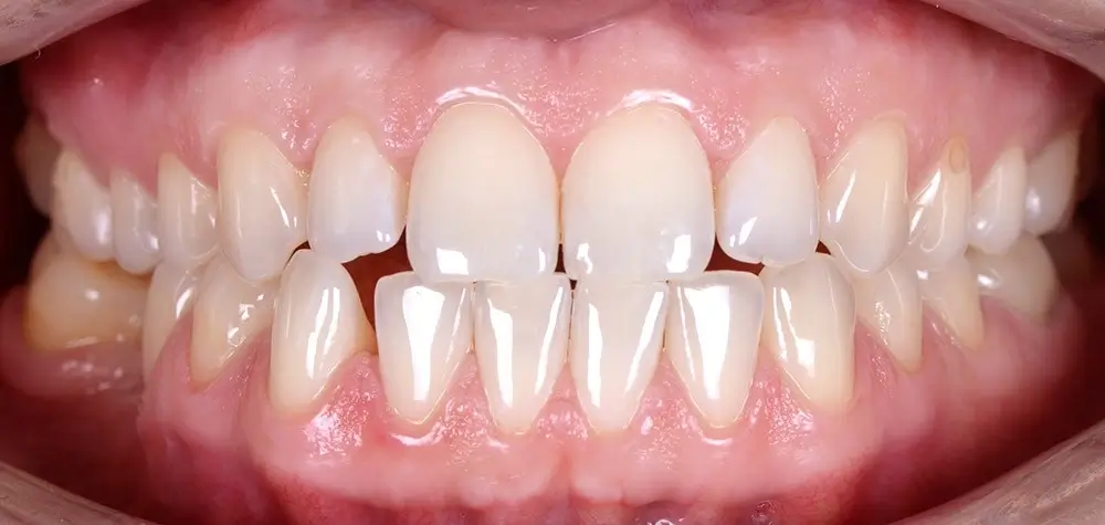 Мезиальный прикус - Кейс 5 — вид спереди до лечения