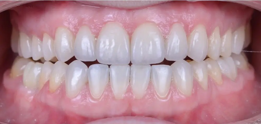 Мезиальный прикус - Кейс 5 — вид спереди после лечения