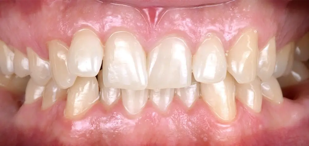 Перекрестный прикус - Кейс 1 — вид спереди до лечения