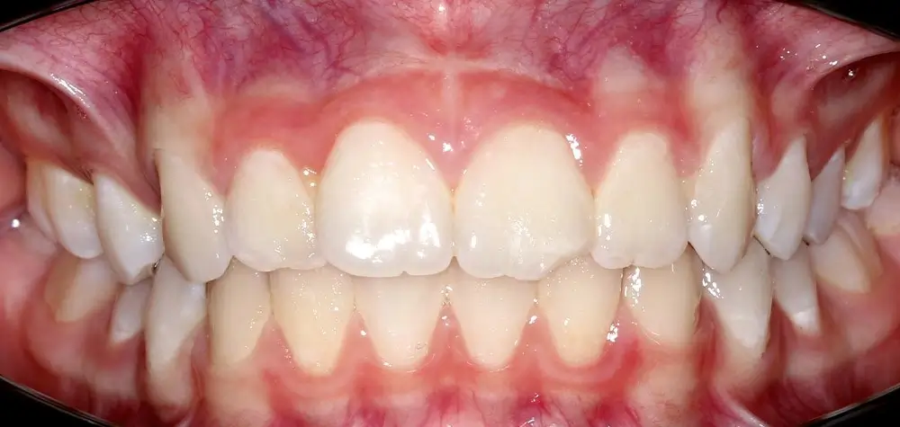 Перекрестный прикус - Кейс 11 — вид спереди до лечения