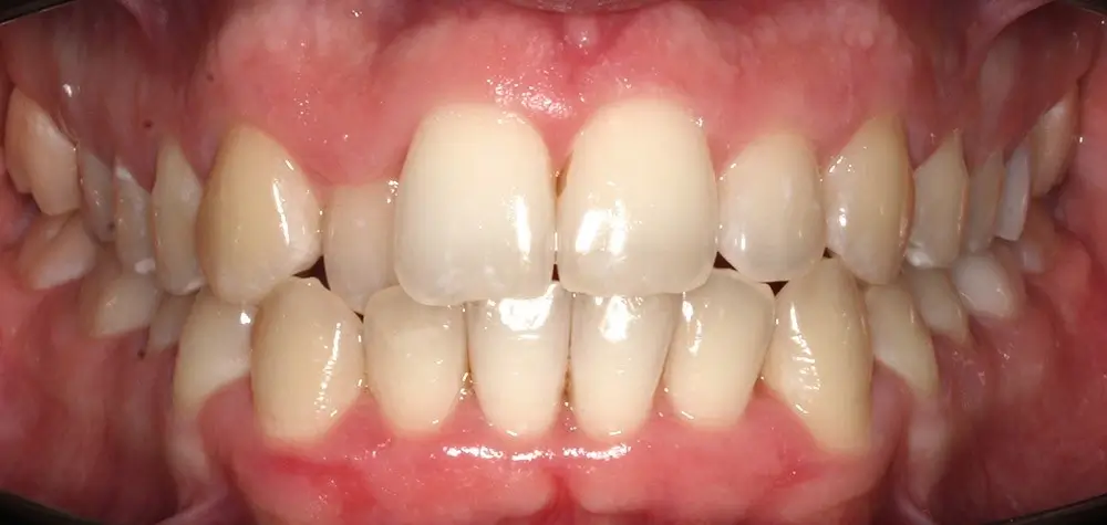 Перекрестный прикус - Кейс 14 — вид спереди до лечения