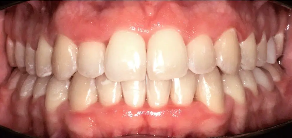 Перекрестный прикус - Кейс 14 — вид спереди после лечения