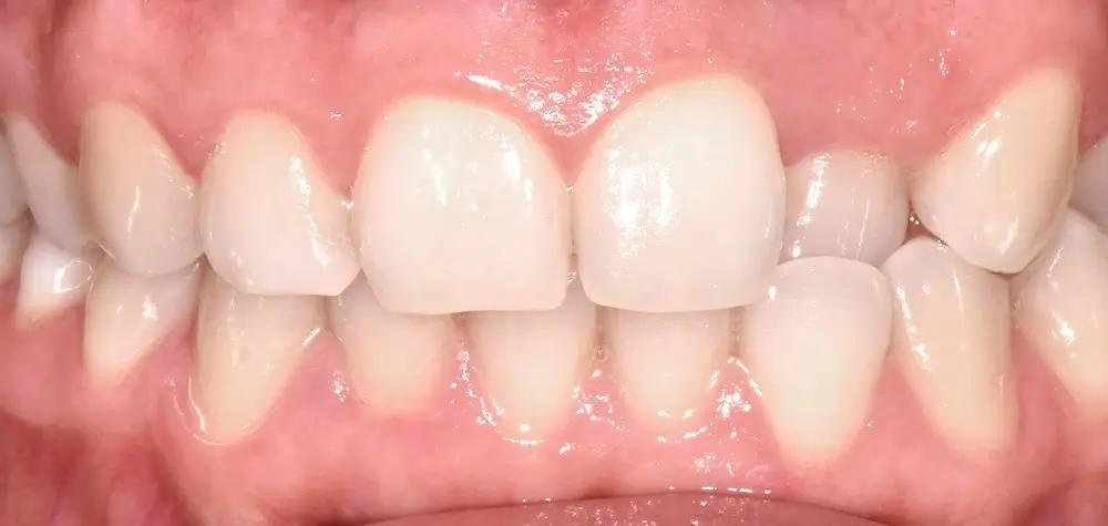 Перекрестный прикус - Кейс 2 — вид спереди до лечения