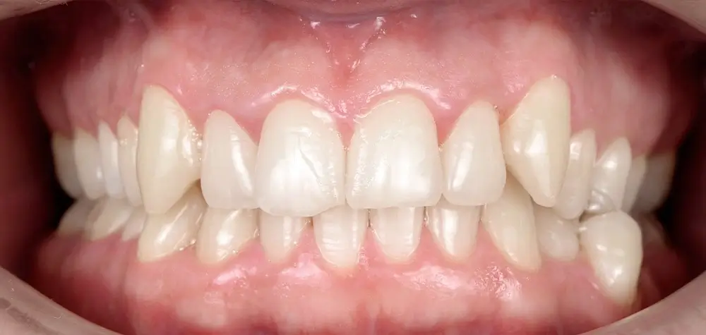 Перекрестный прикус - Кейс 5 — вид спереди до лечения