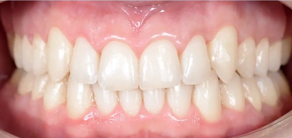 Перекрестный прикус - Кейс 5 — вид спереди после лечения