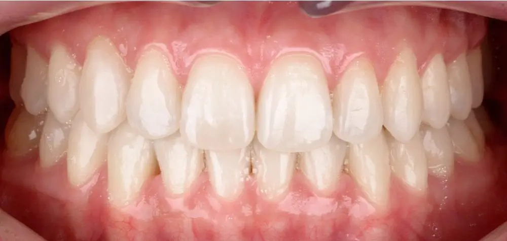 Перекрестный прикус - Кейс 6 — вид спереди после лечения