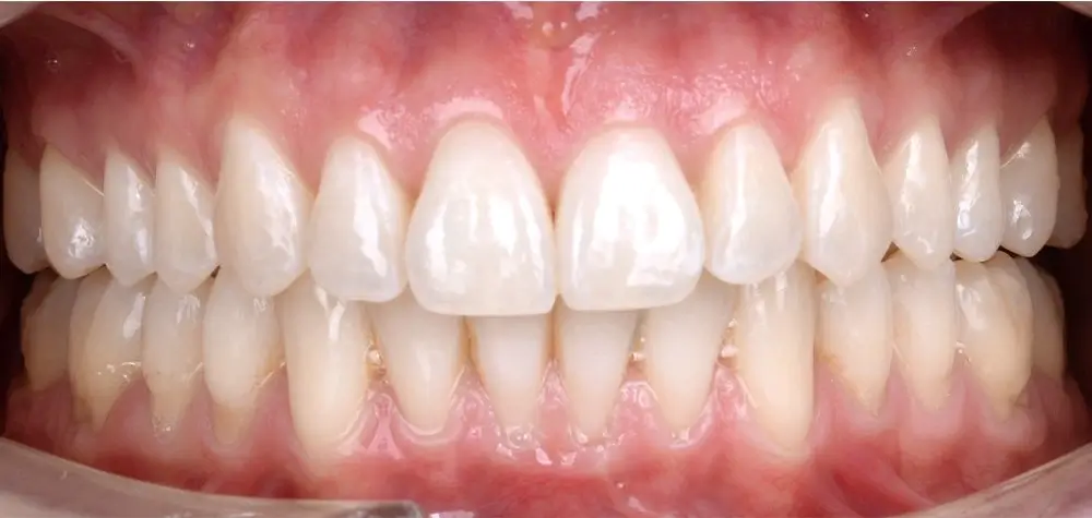 Перекрестный прикус - Кейс 7 — вид спереди после лечения