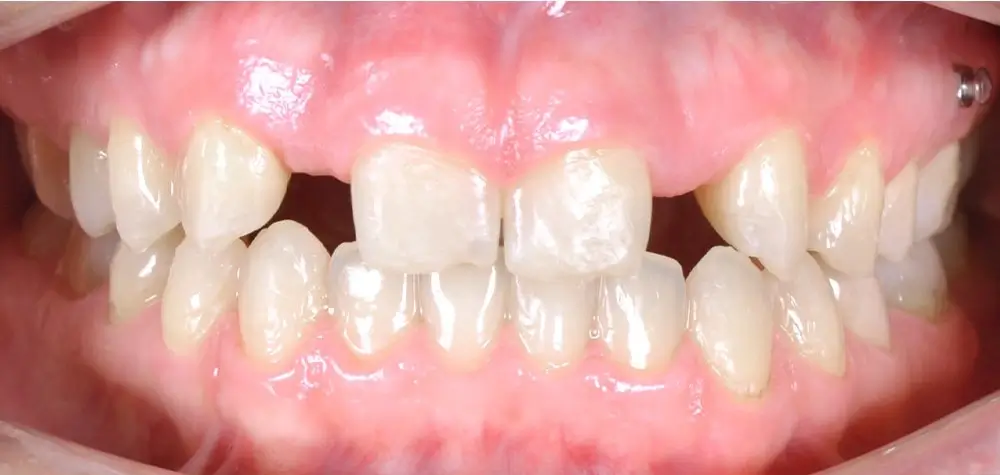 Перекрестный прикус - Кейс 8 — вид спереди после лечения