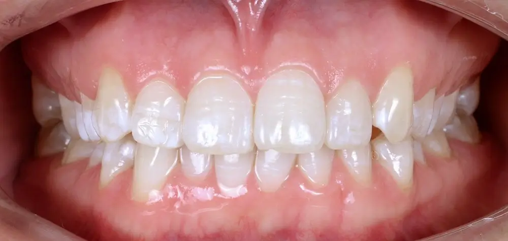 Скученность - Кейс 1 — вид спереди до лечения