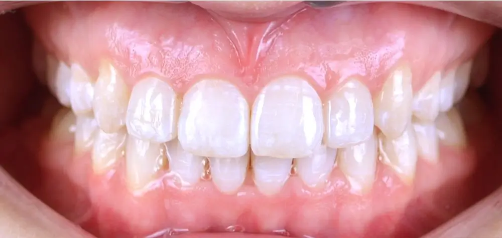 Скученность - Кейс 1 — вид спереди после лечения