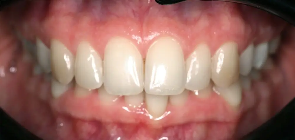 Скученность - Кейс 13 — вид спереди до лечения