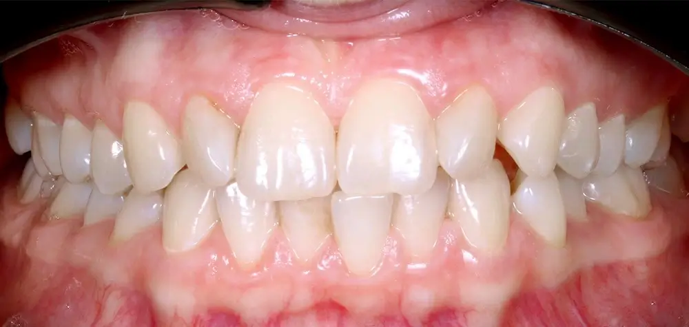 Скученность - Кейс 15 — вид спереди до лечения