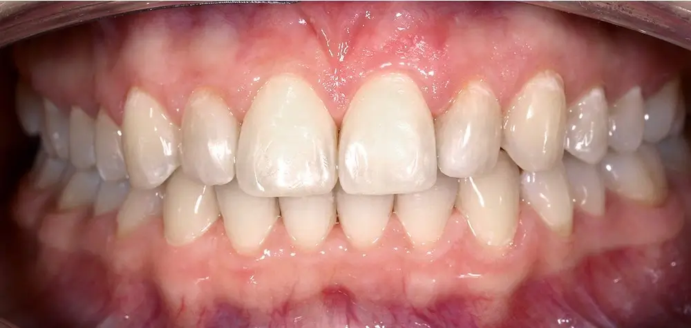 Скученность - Кейс 15 — вид спереди после лечения