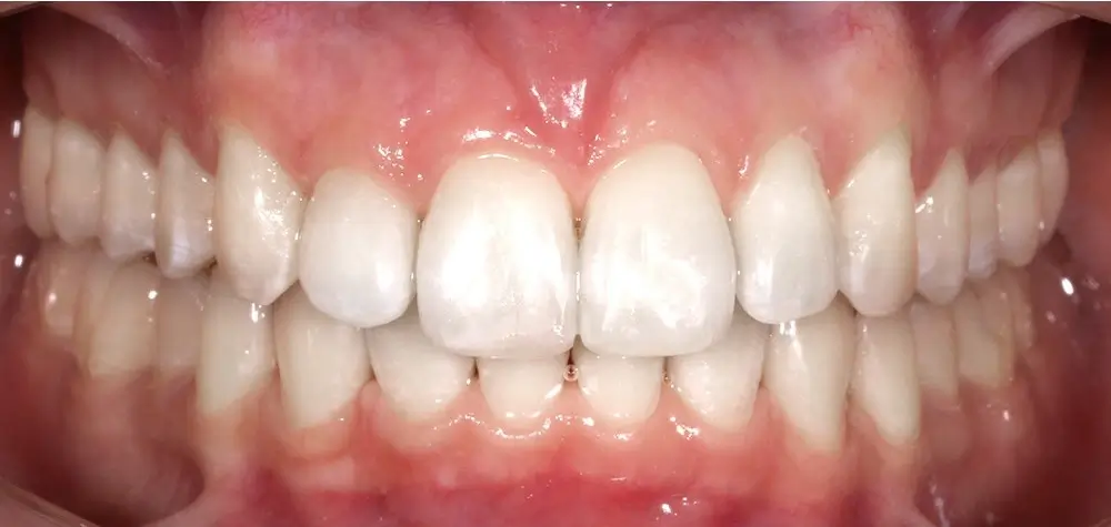 Скученность - Кейс 17 — вид спереди после лечения