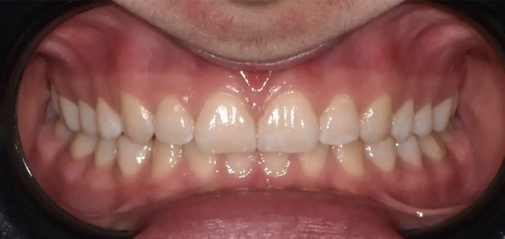 Скученность - Кейс 19 — вид спереди до лечения