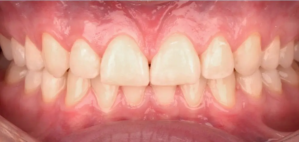 Скученность - Кейс 19 — вид спереди после лечения