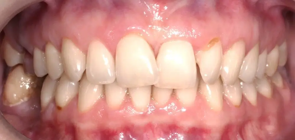 Скученность - Кейс 21 — вид спереди до лечения