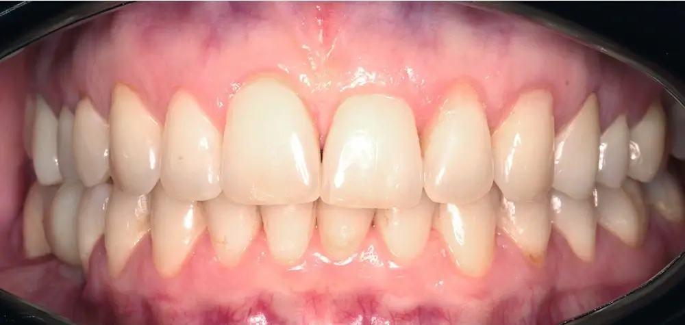 Скученность - Кейс 21 — вид спереди после лечения