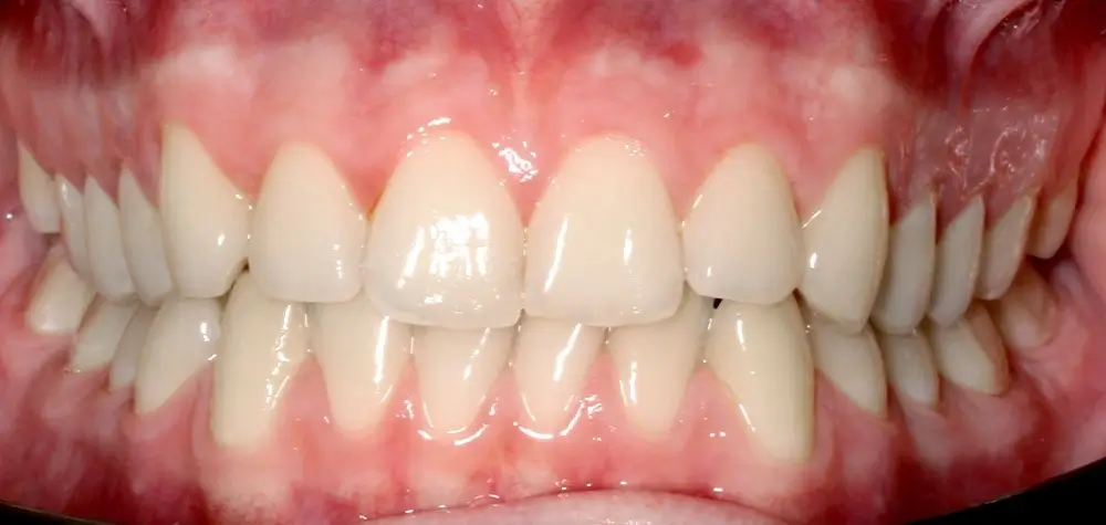 Скученность - Кейс 25 — вид спереди до лечения