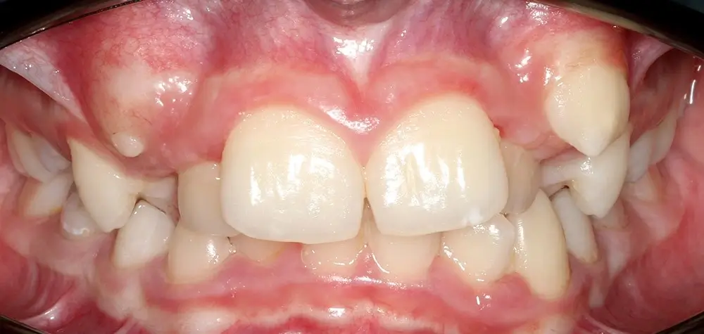 Скученность - Кейс 26 — вид спереди до лечения